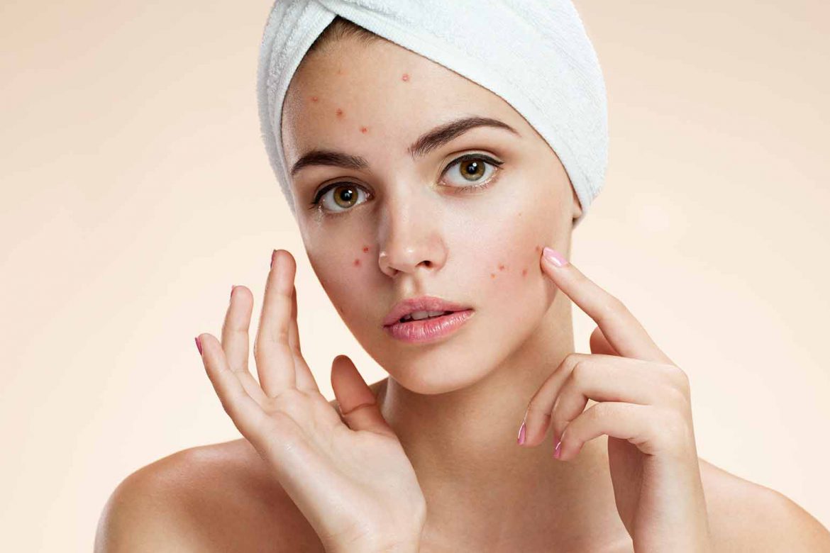 how to reduce face pimples naturally