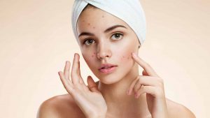how to reduce face pimples naturally