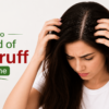 How to Get Rid of Dandruff at Home