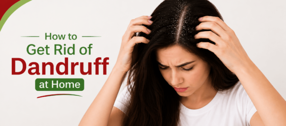 How to Get Rid of Dandruff at Home